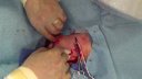 How to place a chest port catheter